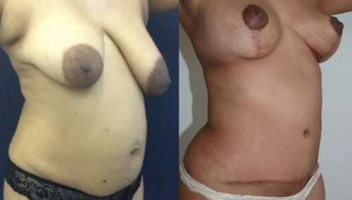 Before and after Mommy Makeover Colombia - Premium Care Plastic Surgery