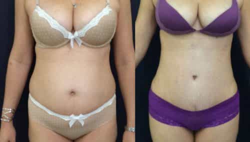Before and after Mommy Makeover Colombia - Premium Care Plastic Surgery
