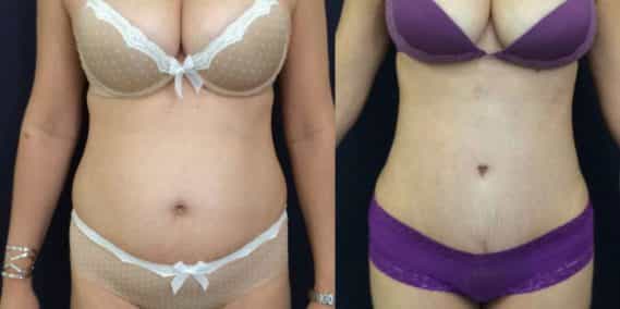 Before and after Mommy Makeover Colombia - Premium Care Plastic Surgery