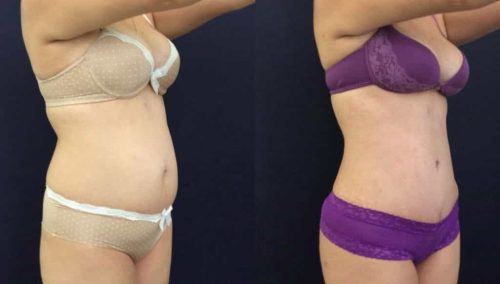 Before and after Mommy Makeover Colombia - Premium Care Plastic Surgery