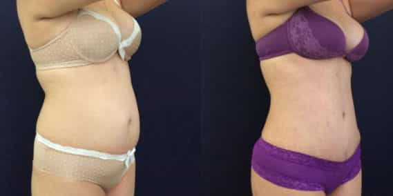 Before and after Mommy Makeover Colombia - Premium Care Plastic Surgery