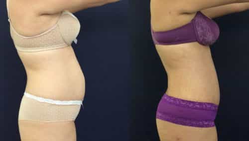 Before and after Mommy Makeover Colombia - Premium Care Plastic Surgery