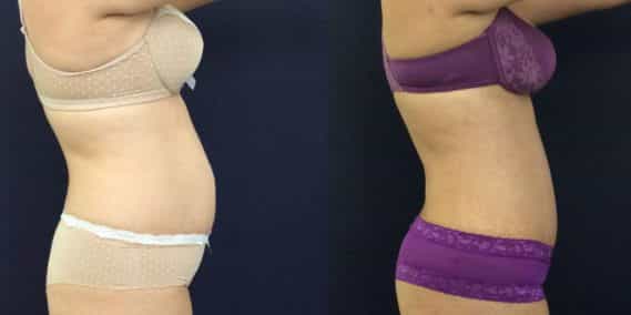 Before and after Mommy Makeover Colombia - Premium Care Plastic Surgery
