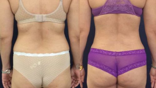 Before and after Mommy Makeover Colombia - Premium Care Plastic Surgery