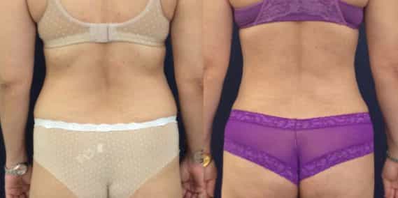 Before and after Mommy Makeover Colombia - Premium Care Plastic Surgery
