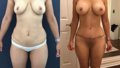 Before and after Mommy Makeover Colombia - Premium Care Plastic Surgery