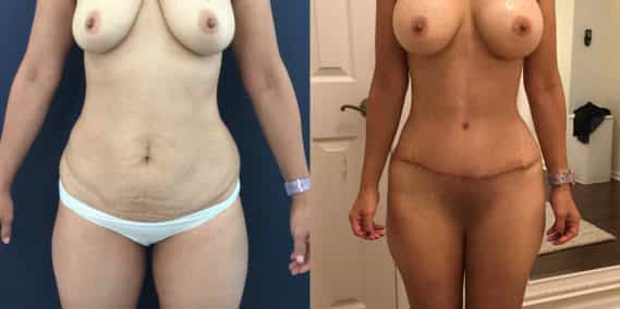 Before and after Mommy Makeover Colombia - Premium Care Plastic Surgery