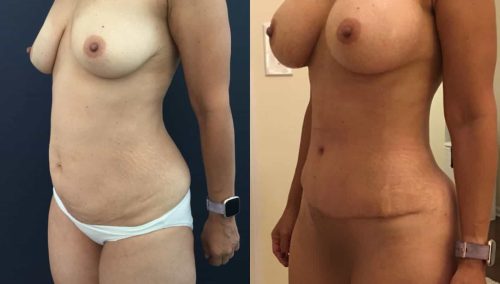 Before and after Mommy Makeover Colombia - Premium Care Plastic Surgery