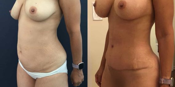 Before and after Mommy Makeover Colombia - Premium Care Plastic Surgery
