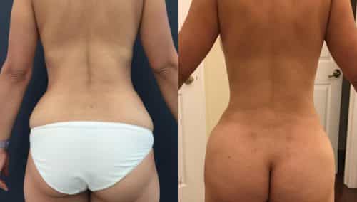 Before and after Mommy Makeover Colombia - Premium Care Plastic Surgery
