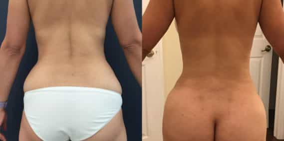 Before and after Mommy Makeover Colombia - Premium Care Plastic Surgery