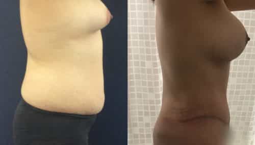 Before and after Mommy Makeover Colombia - Premium Care Plastic Surgery
