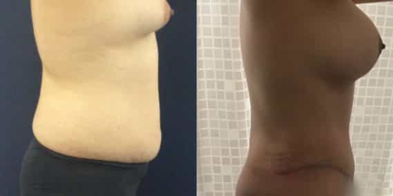 Before and after Mommy Makeover Colombia - Premium Care Plastic Surgery