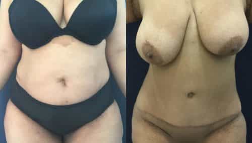 Before and after Mommy Makeover Colombia - Premium Care Plastic Surgery