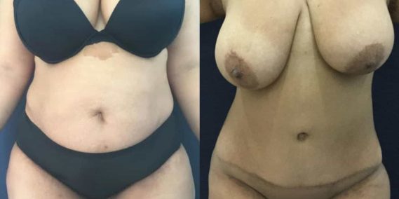 Before and after Mommy Makeover Colombia - Premium Care Plastic Surgery