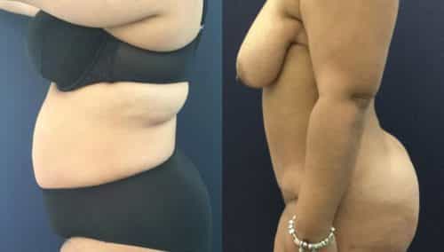 Before and after Mommy Makeover Colombia - Premium Care Plastic Surgery