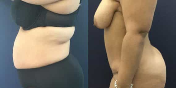 Before and after Mommy Makeover Colombia - Premium Care Plastic Surgery