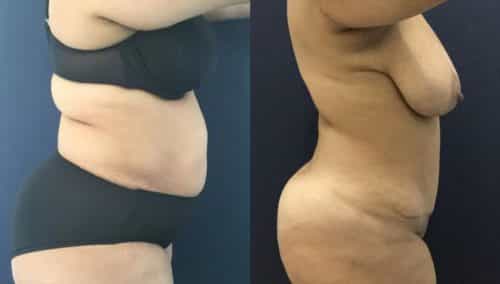 Before and after Mommy Makeover Colombia - Premium Care Plastic Surgery