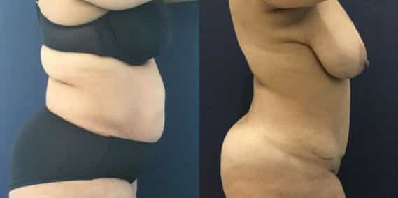 Before and after Mommy Makeover Colombia - Premium Care Plastic Surgery