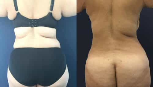 Before and after Mommy Makeover Colombia - Premium Care Plastic Surgery