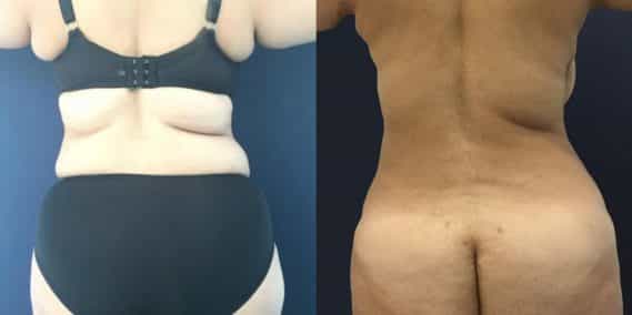 Before and after Mommy Makeover Colombia - Premium Care Plastic Surgery