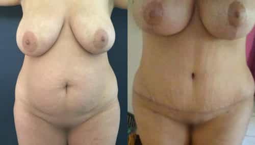 Before and after Mommy Makeover Colombia - Premium Care Plastic Surgery