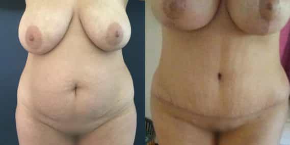 Before and after Mommy Makeover Colombia - Premium Care Plastic Surgery
