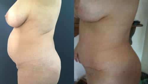 Before and after Mommy Makeover Colombia - Premium Care Plastic Surgery