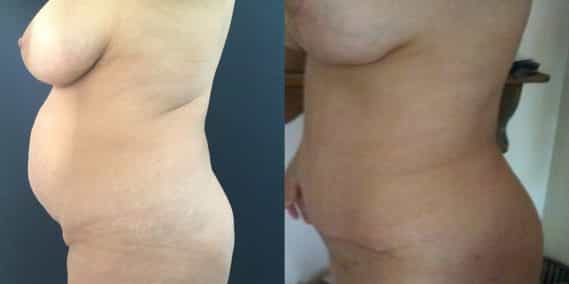 Before and after Mommy Makeover Colombia - Premium Care Plastic Surgery