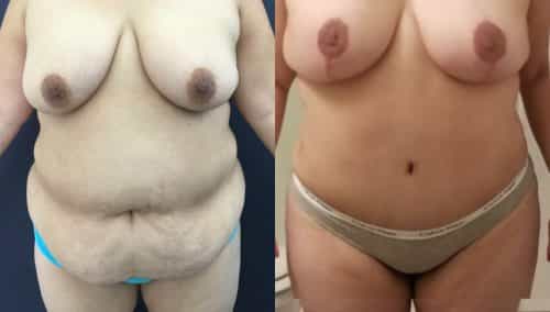Before and after Mommy Makeover Colombia - Premium Care Plastic Surgery