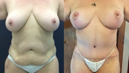 Before and after Mommy Makeover Colombia - Premium Care Plastic Surgery