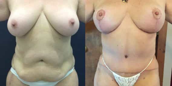 Before and after Mommy Makeover Colombia - Premium Care Plastic Surgery