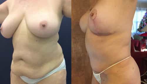 Before and after Mommy Makeover Colombia - Premium Care Plastic Surgery