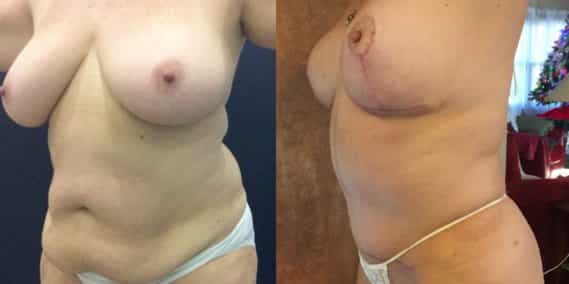 Before and after Mommy Makeover Colombia - Premium Care Plastic Surgery