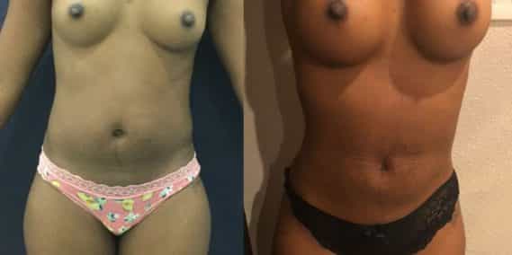 Before and after Mommy Makeover Colombia - Premium Care Plastic Surgery