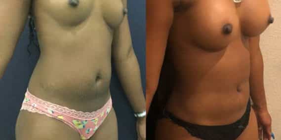 Before and after Mommy Makeover Colombia - Premium Care Plastic Surgery