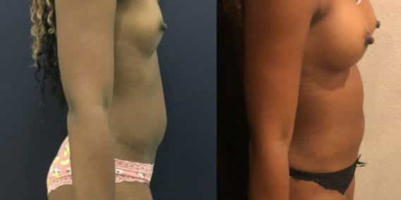 Before and after Mommy Makeover Colombia - Premium Care Plastic Surgery