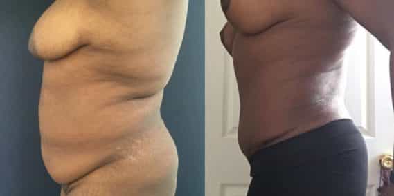 Before and after Mommy Makeover Colombia - Premium Care Plastic Surgery