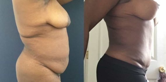 Before and after Mommy Makeover Colombia - Premium Care Plastic Surgery