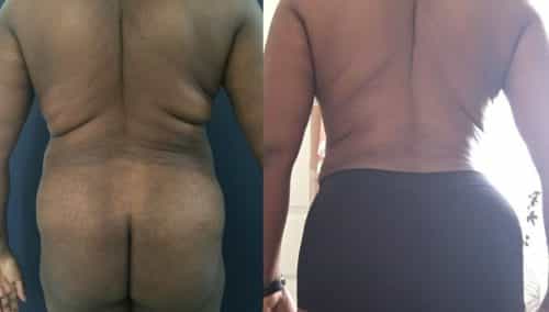 Before and after Mommy Makeover Colombia - Premium Care Plastic Surgery