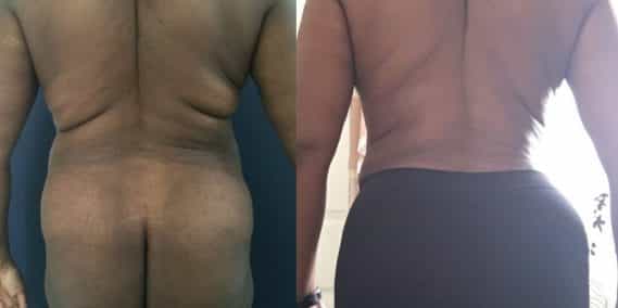 Before and after Mommy Makeover Colombia - Premium Care Plastic Surgery