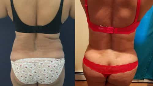 Before and after Mommy Makeover Colombia - Premium Care Plastic Surgery