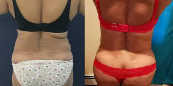 Before and after Mommy Makeover Colombia - Premium Care Plastic Surgery