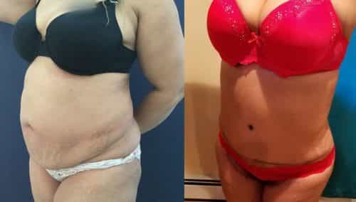 Before and after Mommy Makeover Colombia - Premium Care Plastic Surgery