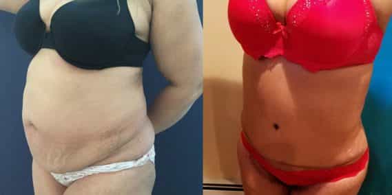 Before and after Mommy Makeover Colombia - Premium Care Plastic Surgery