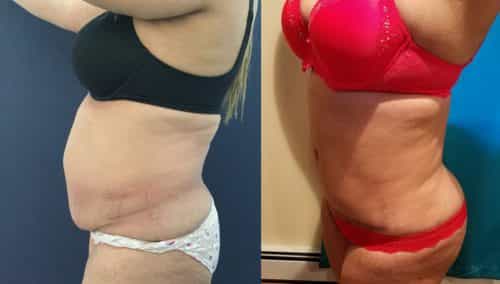 Before and after Mommy Makeover Colombia - Premium Care Plastic Surgery