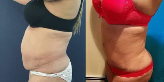 Before and after Mommy Makeover Colombia - Premium Care Plastic Surgery