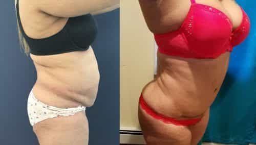 Before and after Mommy Makeover Colombia - Premium Care Plastic Surgery