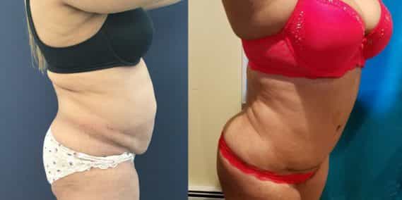 Before and after Mommy Makeover Colombia - Premium Care Plastic Surgery