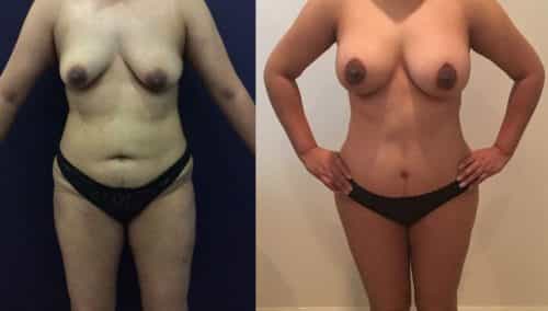Before and after Mommy Makeover Colombia - Premium Care Plastic Surgery